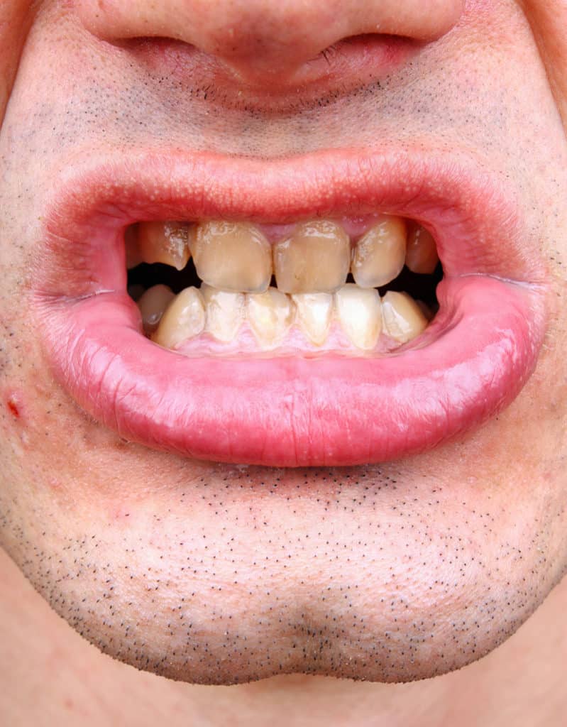 מורסה בשן – הזנחה ודרכי טיפול