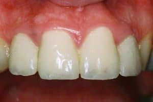 דלקת חניכיים- חניכיים נפוחות ואדומות