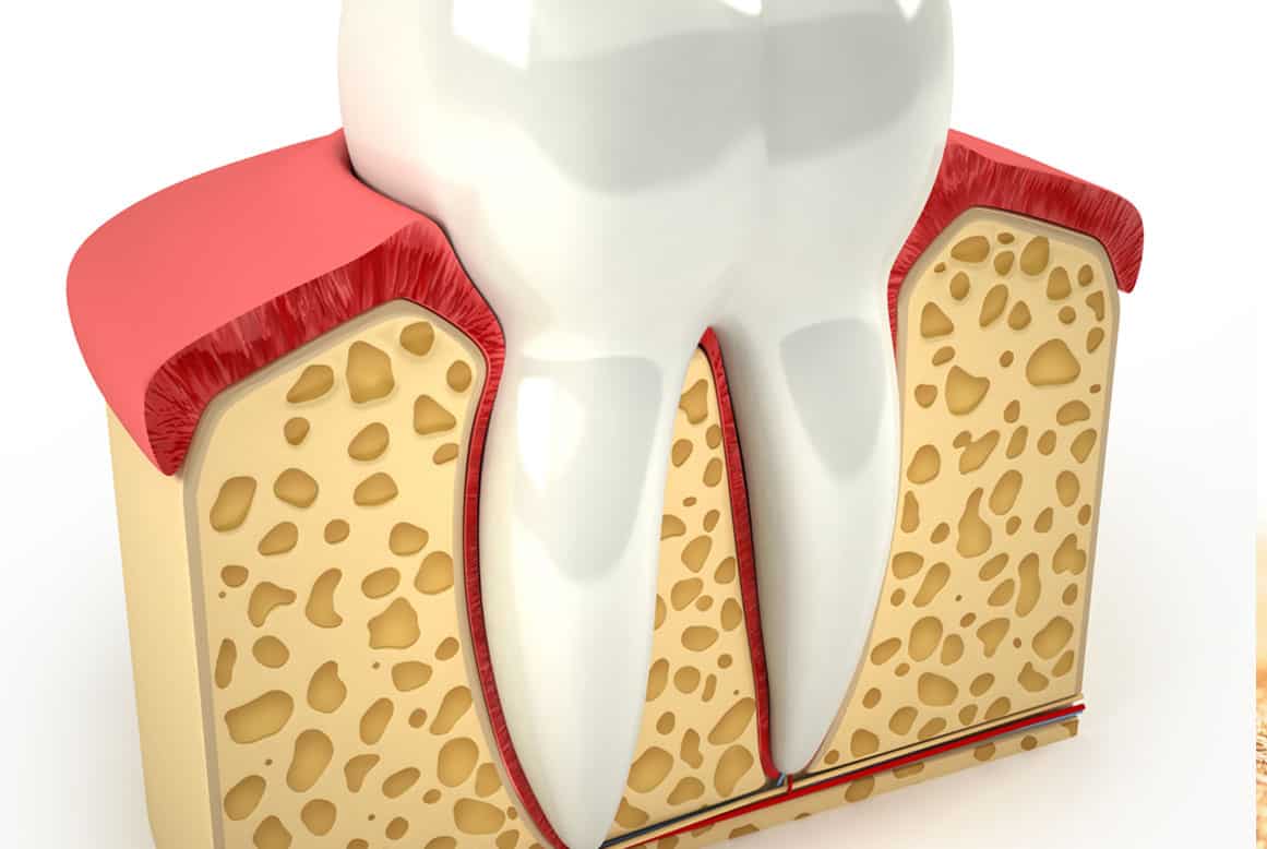 מורסת שיניים – מהי?