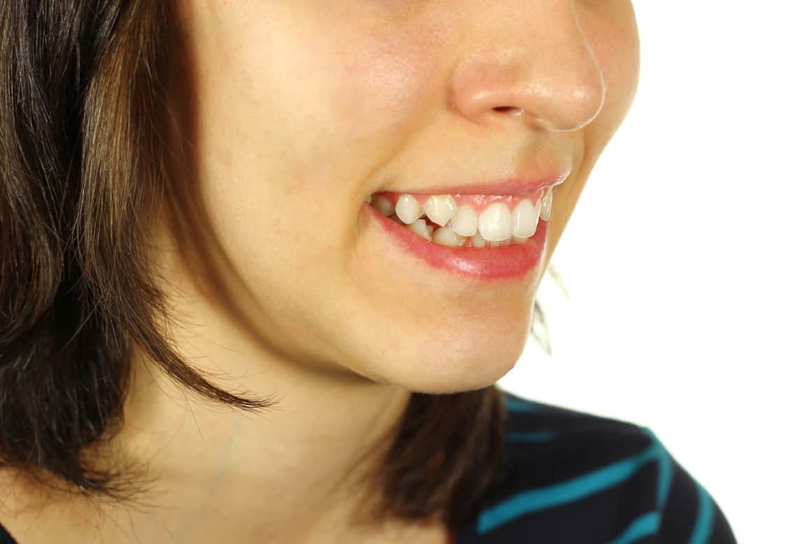 שיניים צהובות – מהם הגורמים לשיניים צהובות?