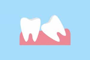 עקירה כירורגית לשן בינה