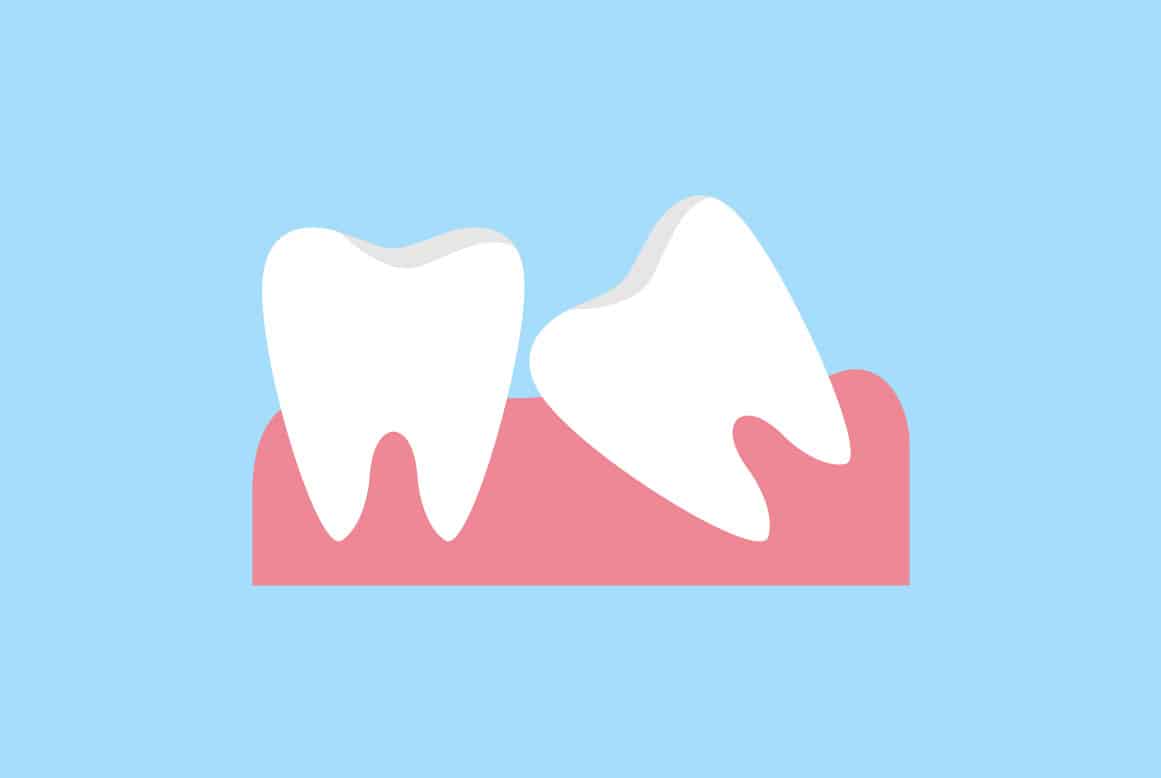 עקירת שן בינה