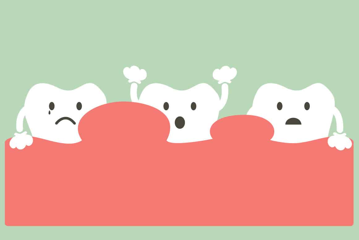 מהי שן בינה מכוסה בחניכיים ואיך מטפלים בה ? האם עלולה להתפתח דלקת בשן בינה?