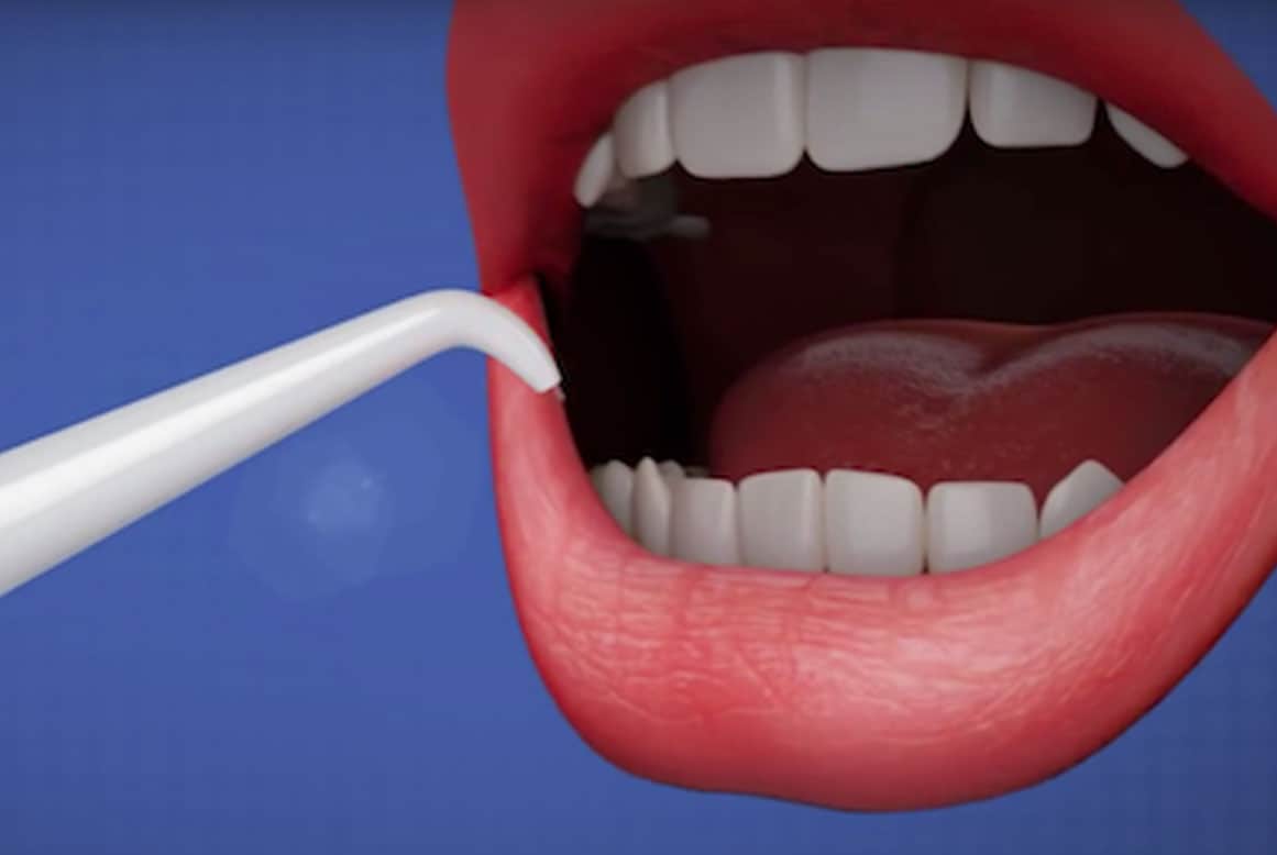 כתמי שיניים – יורד בקלות