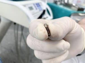 המדריך המלא להוצאת שתלים מהפה (שתל שנכשל)