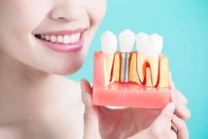 השתלת שן טוחנת - בלי לטחון מים